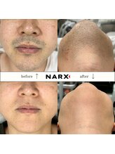 ナークス(NARX)/【ヒゲ】ビフォーアフター