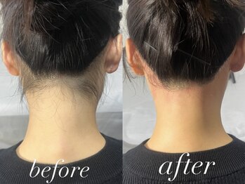 ミルダ(MIRUDA)/首が長く見えるうなじ脱毛。