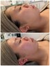 【二重アゴが気になる】針を使わない脂肪分解　5ml