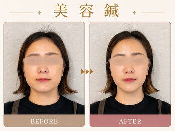 メモラ(memola)/美容鍼【BeforeAfter】