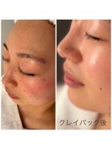 マリーゴールド(marigold)/お悩みのお顔の赤みを薄く☆