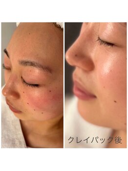 マリーゴールド(marigold)/お悩みのお顔の赤みを薄く☆