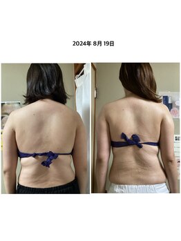 ブリリアント(Brilliant)/背中+二の腕終了