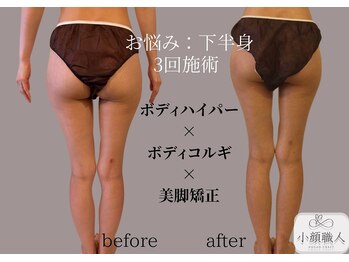 小顔職人/ボディビフォーアフター/30代