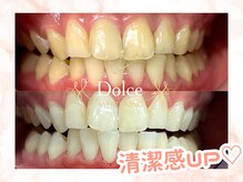 ドルチェ(Dolce)/ビフォーアフター