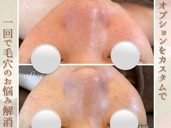 ラナ(LaNa)/毛穴けあ