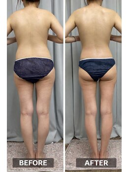 FJ/脂肪撃退コース◆体重減量◎