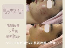 エステティックサロン アールグレー 名古屋駅店/肌質改善/ニキビ