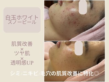 エステティックサロン アールグレー 名古屋駅店/肌質改善/ニキビ