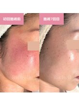 リシェル(Richelle)/ 【GREENPEELセンシダーム】