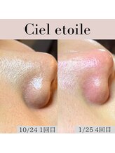 シエルエトワレ/毛穴エクストラクション