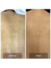 シファ(SHIFA)/背中のシミ、ニキビケア