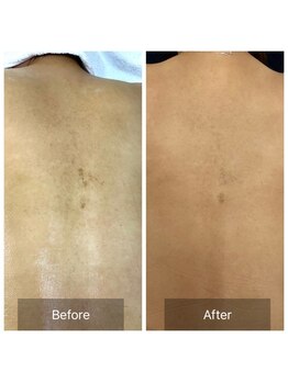 シファ(SHIFA)/背中のシミ、ニキビケア