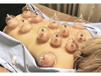 モグサ鍼灸院(MOXA鍼灸院)/カッピングでダルさもスッキリ