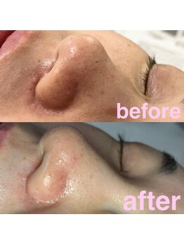 カラン(Calin)/毛穴汚れ角栓除去♪