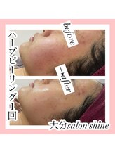 サロンシャイン(Salon Shine)/ハードハーブピーリング１回