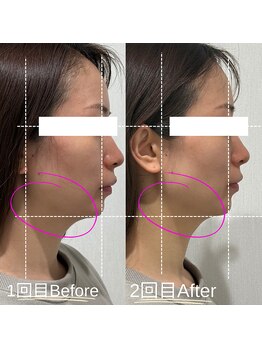 エステティックサロン ラ ベルタ(Esthetic Salon La Belta)/レモンボトル2回