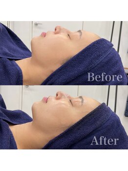 ジョンミー(JONMEE)/小顔矯正で顎下リフトアップ