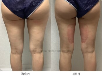 スラリ(SLARI)/【太もも脂肪冷却】期間1か月半