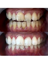 ワールドビューティー(World Beauty)/30代女性/ホワイトニング　6回