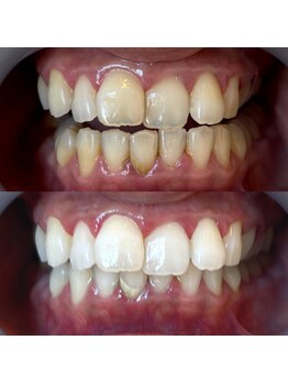 ワールドビューティー(World Beauty)/30代女性/ホワイトニング　6回