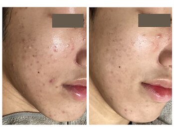 レクラ バイ ドクターエイチ(L'ECLAT by Doctor.H)/ハーブピーリング