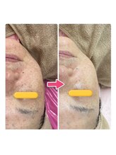 キュライム カブール町田店/59歳★周囲に驚かれる美肌へ