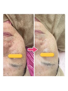 キュライム カブール町田店/59歳★周囲に驚かれる美肌へ