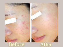 ハル(HARU.)/HARU.式ハーブピーリング5回