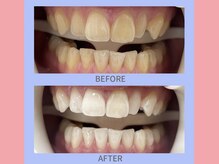 ココティ ホワイトニング(Cocotii)/ビフォーアフター