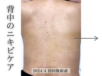 フェイシャルヴィム(FACIAL VIM)/新メニュー★背中のニキビケア