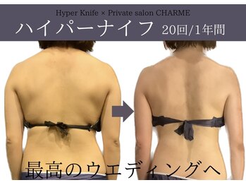 シャルム(charme)/ブライダル痩身！ハイパーナイフ