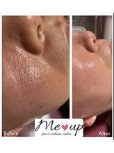 ミーアップ(Me up)/毛穴の開きも月一回の来店で！