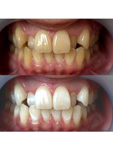 ワールドビューティー(World Beauty)/20代女性/ホワイトニング　6回