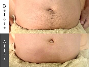 メンズオージー 岡山中区(men's O.G)/メンズ脱毛|へそ下脱毛