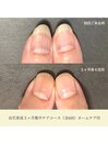自爪育成３ケ月集中ケアコース