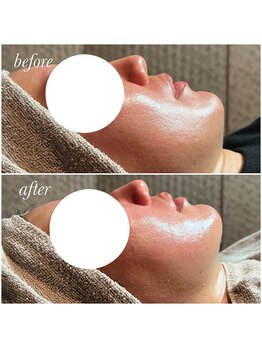 リゾートデバリ(ReSORT de BALI)/最新小顔メニュー