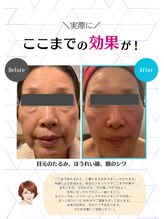 アンプリール(emplir)/　【シワ・タルミ】