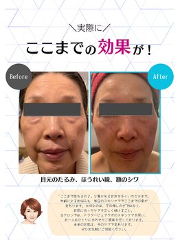 アンプリール(emplir)/ 【シワ・タルミ】