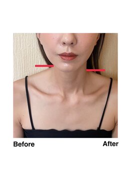 ミッシュ(Mish)の写真/【大気汚染物質や余分な皮脂や角質を取り除く】セルキュア4++美顔器で美肌&フェイスラインのたるみも綺麗に