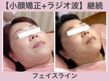 アンリエッタ(Unlieta)/【フェイスラインの変化】