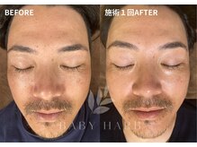 フィズ 経堂店(FIS)/☆ハーブピーリングで美肌に☆