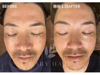 フィズ 経堂店(FIS)/☆ハーブピーリングで美肌に☆