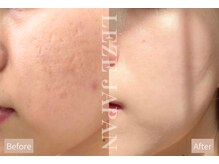 ルーナ 恵比寿(Luna)/凸凹色黒ずみ改善にはコレ！