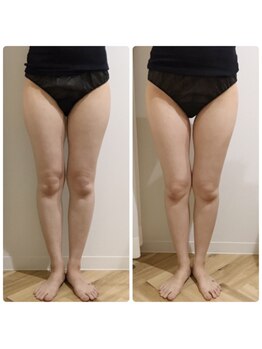 リボディ プラチナ(Rebody platinum)/脂肪冷却×半身ケア