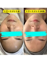 エステティックサロン S/くすみ＆シミケア