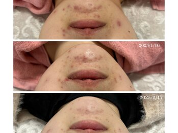 メルシア(merucia)/跡、ニキビケア、赤み改善