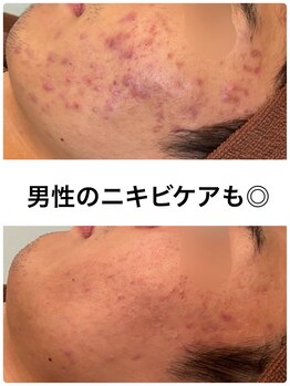 ビオエル 横浜店(Bioel)/ハーブピーリング/横浜