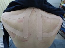 カイロプラクティック 大森整体院/テーピング施術例（肩甲骨周辺）