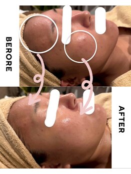 ポノ(PONO)/水光ピーリング